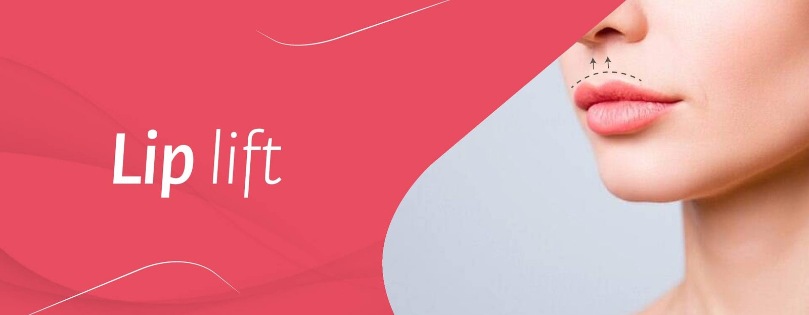 Lip Lift